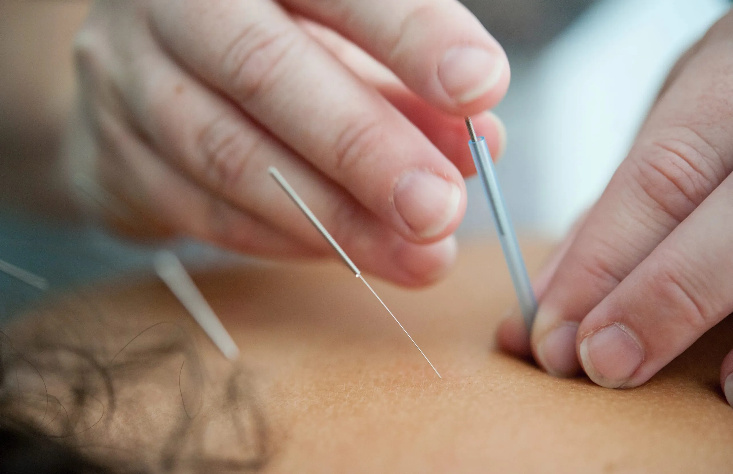 Acupuncture, an ancient practice rooted in traditional Chinese medicine, has gained popularity in recent years as a powerful tool for stress reduction and pain management.